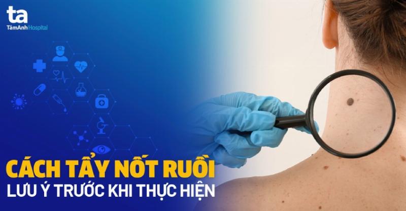 Tác hại của việc tự ý tẩy nốt ruồi tại nhà bằng các phương pháp dân gian không an toàn