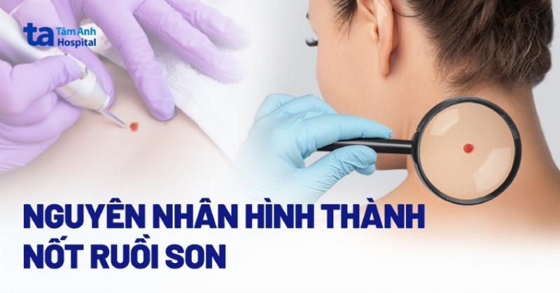 Minh họa ý nghĩa màu sắc, kích thước và hình dạng của nốt ruồi trên cơ thể người theo Nhân Tướng Học
