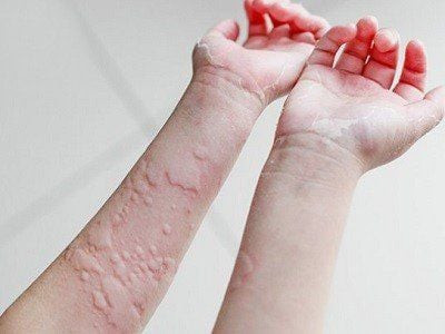 Người bệnh bị nổi mề đay, phát ban do dị ứng với calci carbonat vitamin D3, cần tham khảo ý kiến bác sĩ.