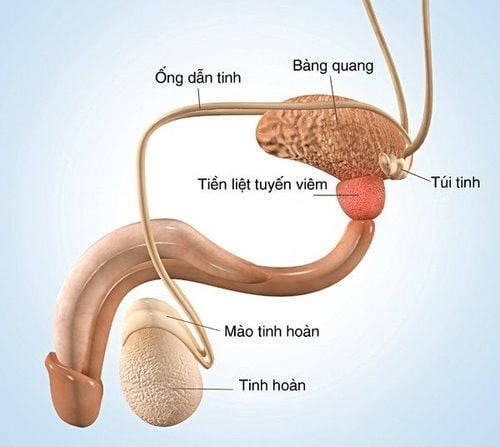 Hình ảnh minh họa viêm tuyến tiền liệt, một nguyên nhân có thể gây tiểu ra máu và nước tiểu màu nâu đỏ.