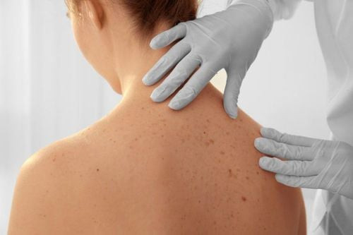 Dấu hiệu ung thư da có thể gián tiếp ảnh hưởng đến màu nước tiểu, với những nốt ruồi bất thường.