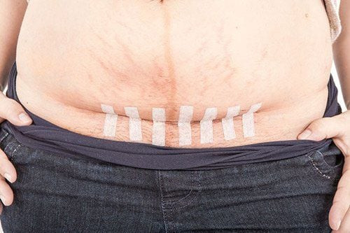 Khâu tầng sinh môn tạo sự thuận lợi cho mẹ bầu khi sinh nở