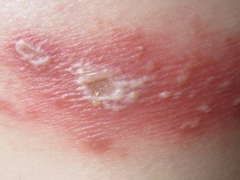Vết kiến ba khoang cắn gây mụn nước, phỏng rộp trên da