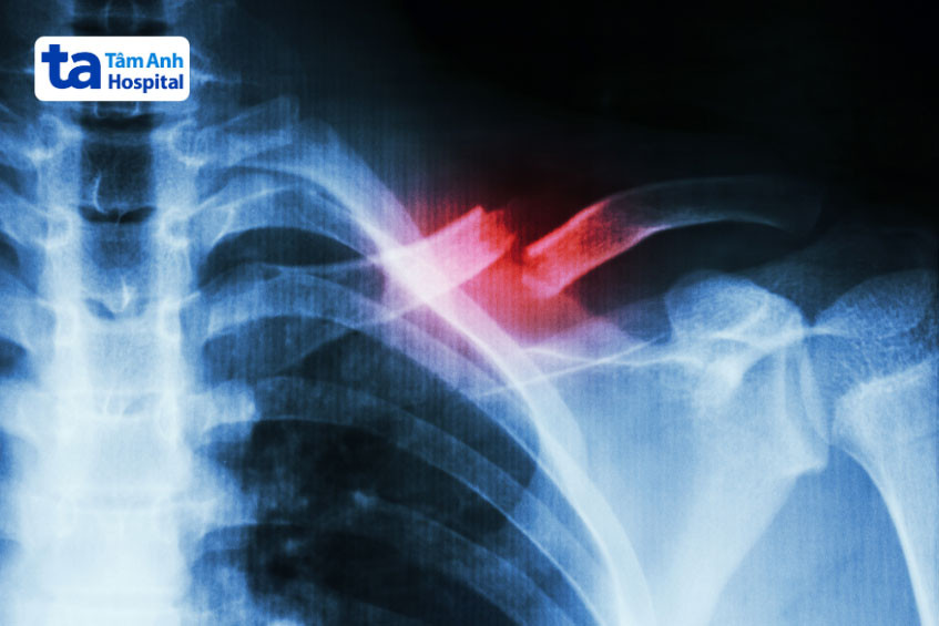 Gãy xương đòn gây đau vai gáy bên trái