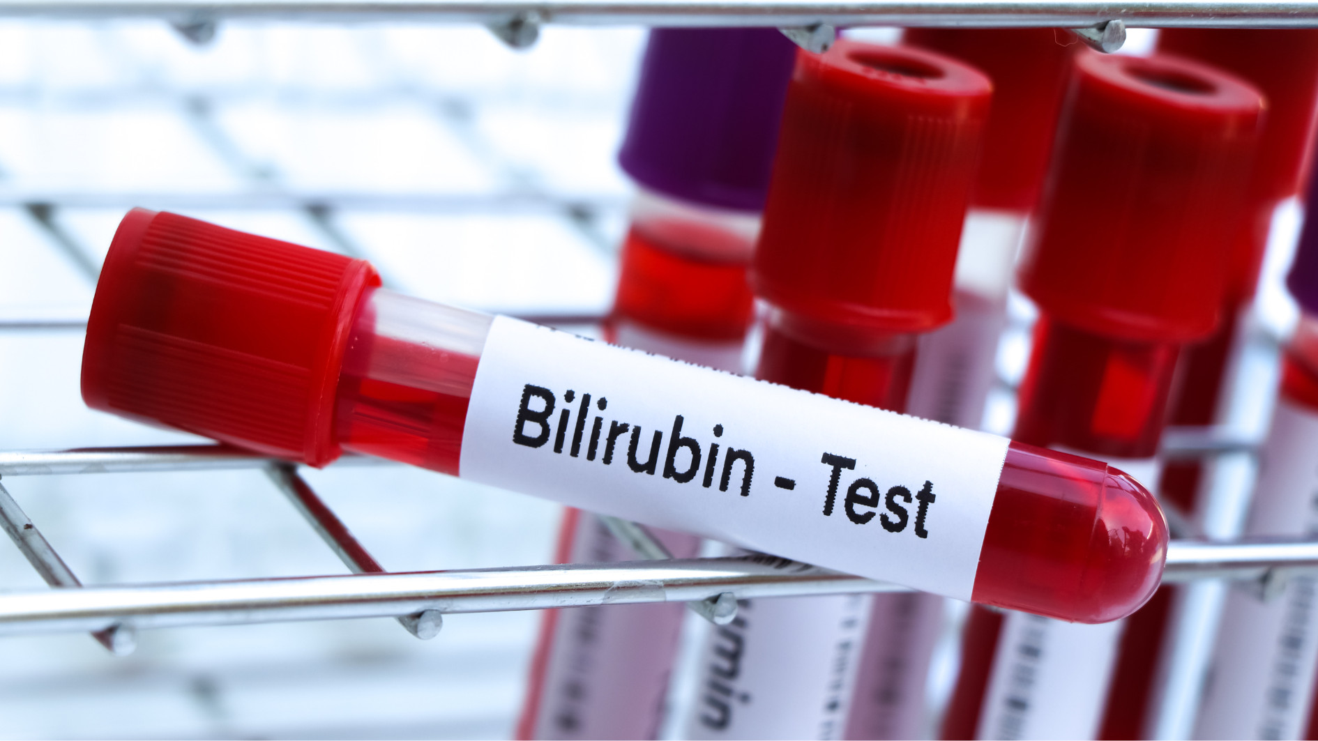 Chỉ số bilirubin bao nhiêu là nguy hiểm được nhiều người quan tâm