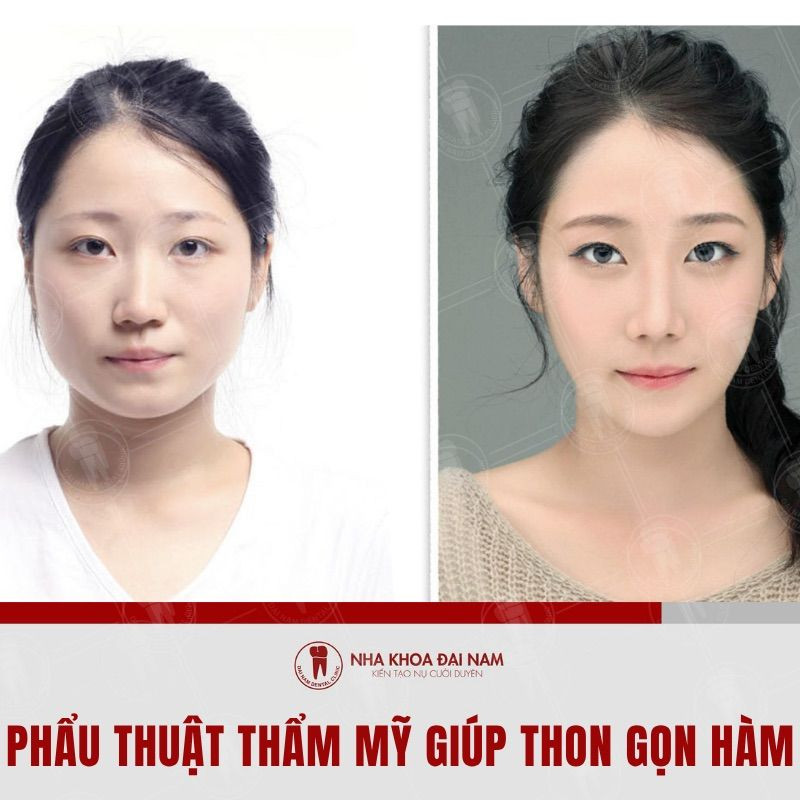 Phẫu thuật thẩm mỹ để có khuôn mặt trái xoan