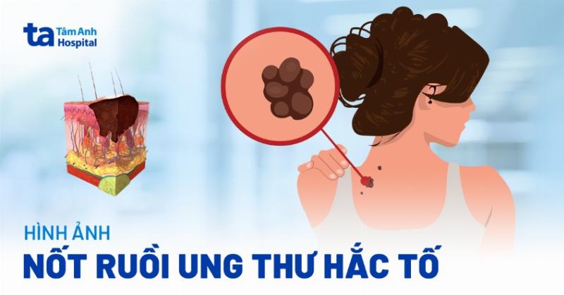 Hình ảnh minh họa dấu hiệu ABCDE của nốt ruồi nghi ngờ ung thư da theo lời khuyên da liễu