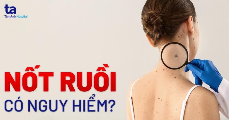 Thăm khám bác sĩ da liễu khi có nốt ruồi bất thường ở bàn chân