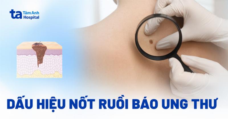 Cách kiểm tra nốt ruồi dưới bàn chân tìm dấu hiệu bất thường