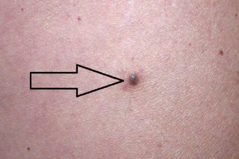 Khám phá các vị trí nốt ruồi trên mu bàn tay và ý nghĩa cụ thể của chúng