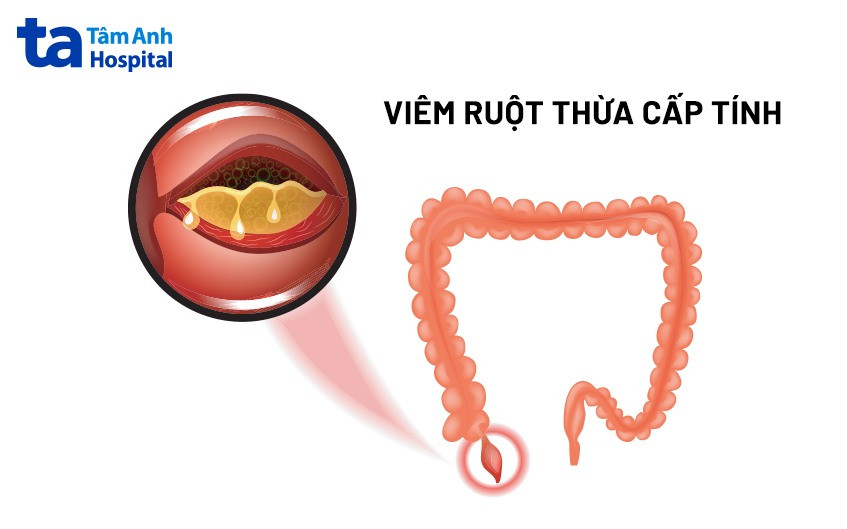 Dấu hiệu đau bụng trên bên trái do viêm loét dạ dày