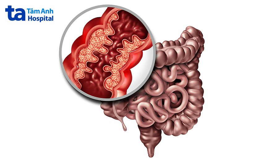Hình ảnh nội soi minh họa tình trạng viêm ruột có thể gây đau bụng trên bên trái